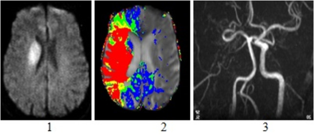 IRM Cérébrale - AVC | Imagerie Médicale Lyon Mermoz